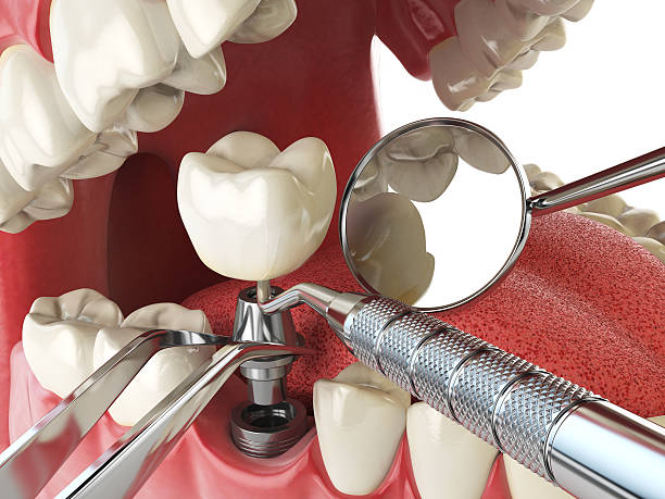 Best Emergency Root Canal Treatment in Rosedale, WA